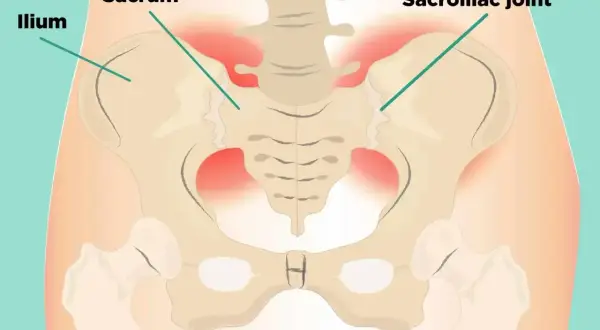 Ilustracja kości miednicy z zaznaczonym stawem krzyżowo biodrowym i obszarami bólu.