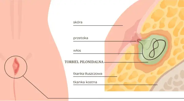 Przekrój skóry ukazujący torbiel pilonidalną z włosiem w środku, otoczoną tkanką tłuszczową i kostną.