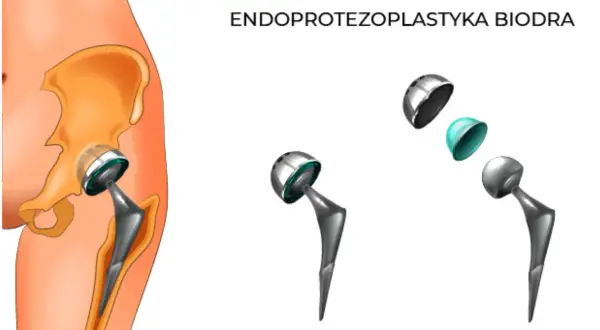 Schemat endoprotezy stawu biodrowego: implant w kości miednicy i kości udowej, oraz rozłożone elementy endoprotezy.