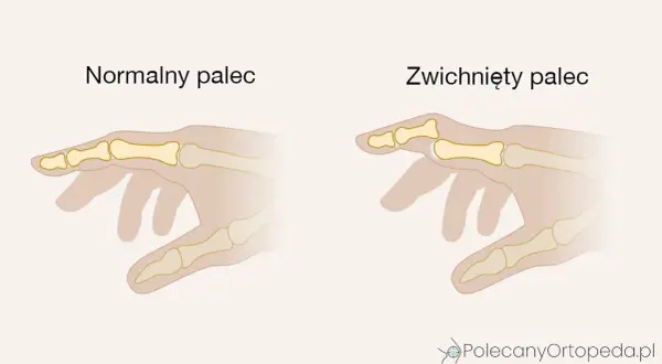 Skręcenie ręki: objawy, pierwsza pomoc i leczenie krok po kroku