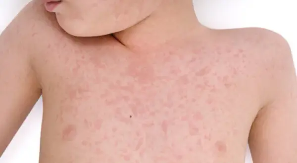 Alergia pokarmowa u dzieci: objawy skórne, przyczyny i jak pomóc?