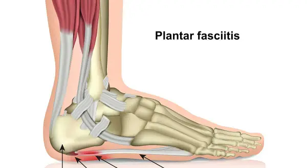 Anatomische Darstellung des Fußes, die zeigt, was ist plantarfasziitis: Entzündung der Plantarfaszie an der Ferse.