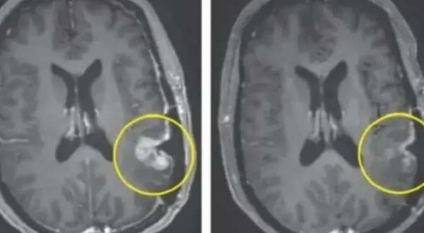 Jak odróżnić nerwicę od guza mózgu i uniknąć błędnej diagnozy