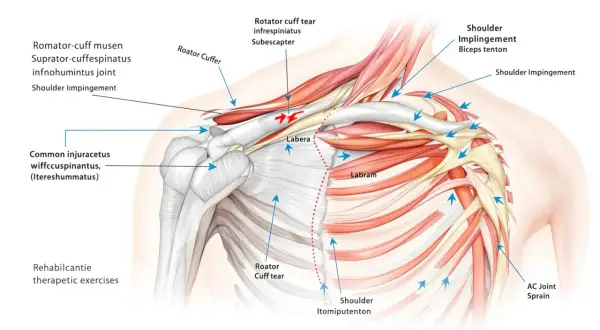 Anatomical illustration of a boxers shoulder, detailing rotator cuff tears, impingement, and labrum injuries.