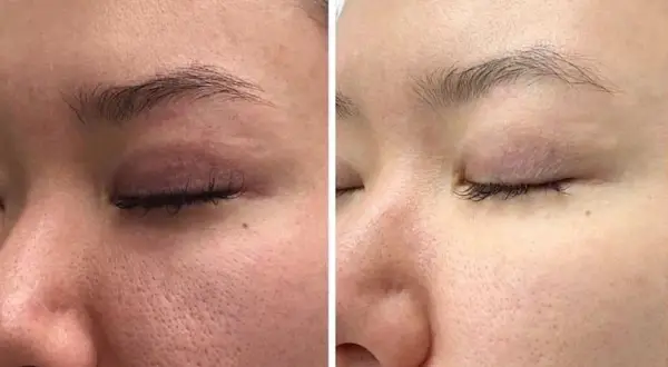 Vergleich: Haut mit großen Poren vor und nach der Anwendung von Retinol. Die Haut wirkt feiner und ebenmäßiger.