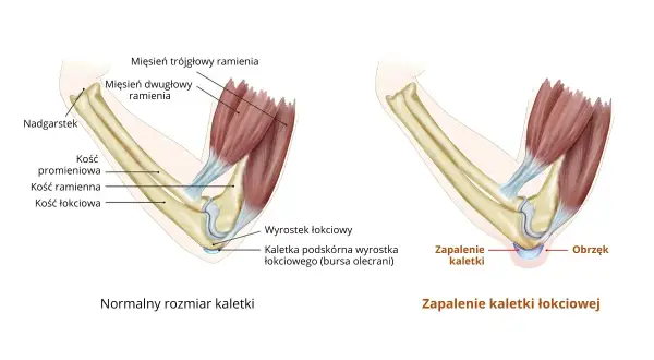 Ilustracja porównująca zdrową kaletkę łokciową z zapaloną, z widocznymi kośćmi i mięśniami.