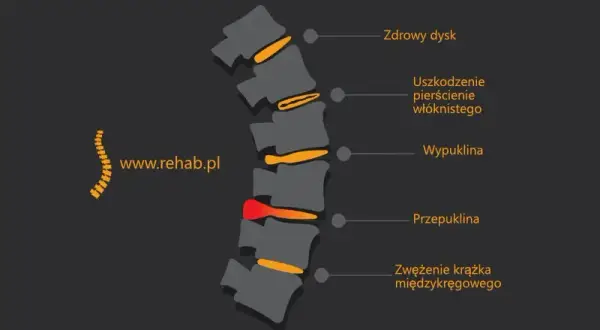 Skręcenie kręgosłupa lędźwiowego: objawy, przyczyny i co robić?