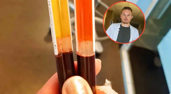 Dwie probówki z krwią, potencjalnie badane pod kątem markerów nowotworowych jelita grubego. W tle lekarz w białym fartuchu.