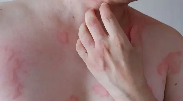 Czy pietruszka uczula? Objawy alergii, które warto znać