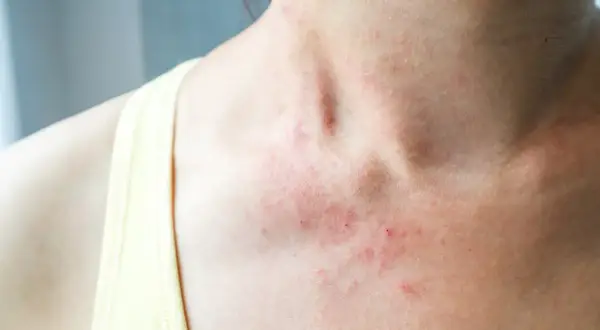 Czerwone, swędzące plamy na szyi i dekolcie wskazują na **alergia skórna**.