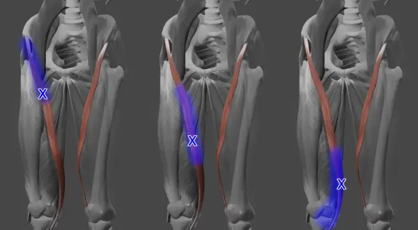 Musculus sartorius: Der Schneider-Muskel, hervorgehoben in Blau, verläuft diagonal über den Oberschenkel.