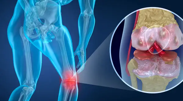 Menschliches Knie mit entzündetem Gelenk. Nahaufnahme zeigt abgenutzten Knorpel, der den Aufbau von Knorpel verdeutlicht.