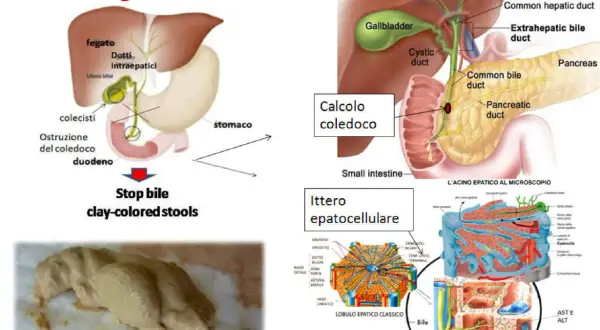 Feci ipocoliche, color argilla, dovute a ostruzione biliare. L'immagine mostra un diagramma del sistema biliare e un esempio di feci chiare.