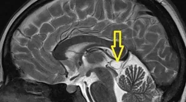 Przekrój mózgu z zaznaczonym strzałką obszarem szyszynki. Może to być pomocne w diagnostyce guz szyszynki objawy.