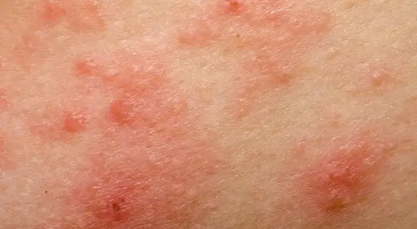 Skóra z zaczerwienionymi, swędzącymi zmianami, które mogą być objawem uczulenia na gluten.