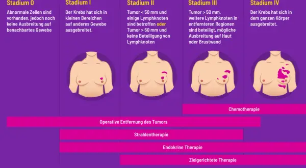 Brustkrebsstadien von 0 bis IV. Bei fortgeschrittenem aggressiver brustkrebs ist Chemotherapie eine Option.