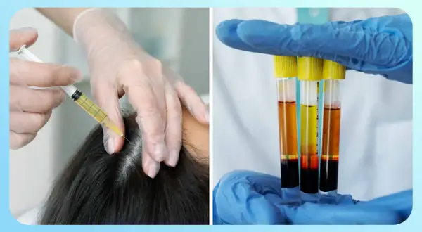 Manos enguantadas aplicando mesoterapia capilar con jeringa y mostrando tubos de ensayo con plasma.