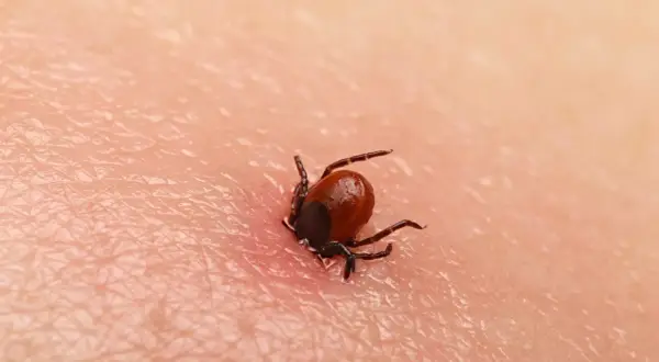 Zbliżenie na wbitego kleszcza na ludzkiej skórze. Pajęczak z ośmioma odnóżami wgryza się w naskórek, widoczny jest zaczerwieniony obszar wokół niego.