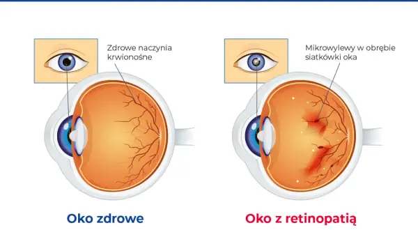Porównanie oka zdrowego z naczyniami krwionośnymi siatkówki i oka z retinopatią cukrzycową, gdzie widoczne są mikrowylewy.