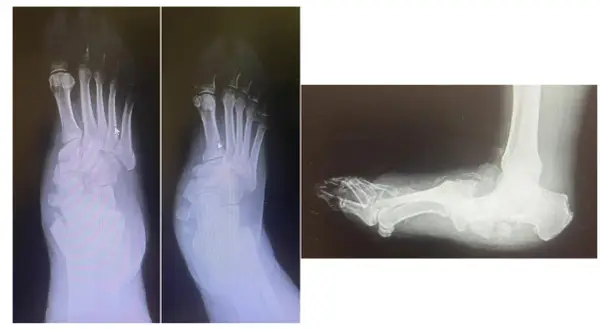 Radiografie del piede con deformità tipica del piede di Charcot, in preparazione per un intervento chirurgico.