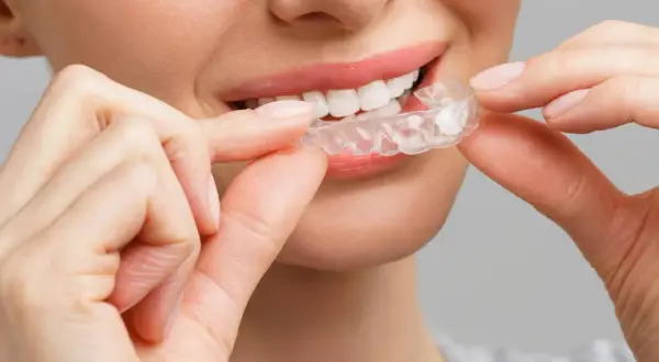 Sorriso smagliante con clear aligners. La donna sorride mentre applica gli apparecchi trasparenti per un sorriso perfetto.