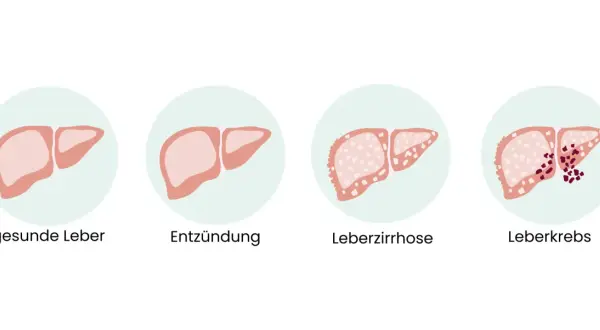 Illustration zeigt gesunde Leber, Entzündung, Leberzirrhose und Leberkrebs. Frühe Anzeichen von Leberkrebs sind oft unspezifisch.