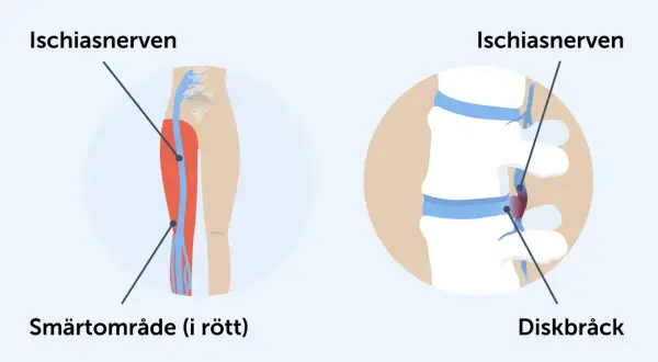 Illustrationer visar iskiasnerven och ett diskbråck som kan orsaka ont mellan skinkorna.