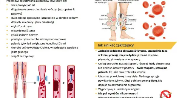 Jak zapobiec zakrzepicy? 4 filary dla zdrowych żył. Sprawdź ryzyko!