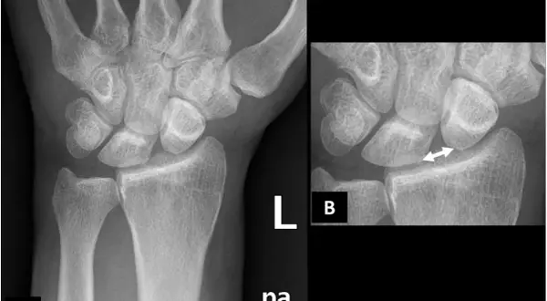 Radiografie del polso. L'immagine B evidenzia un aumento dello spazio tra radio e ulna, indicativo di lesione del legamento triangolare polso.