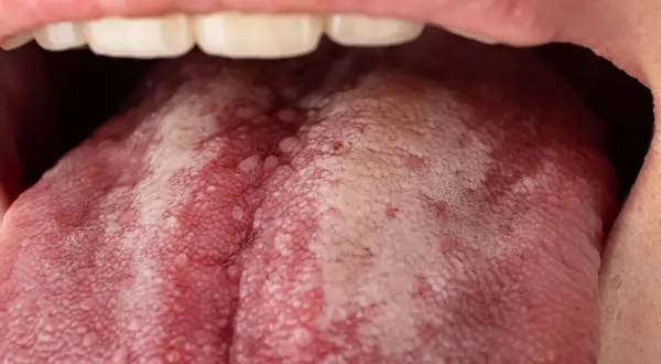 Lengua con una llaga roja y parches blancos, mostrando papilas inflamadas y pequeñas protuberancias.