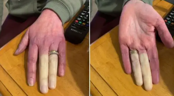 Syndrom Raynauda: Jak rozpoznać objawy i co je wywołuje?