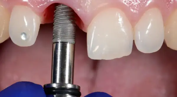 Zabieg wszczepienia implantu dentystycznego w szczękę. Widoczne narzędzie stomatologiczne i fragment implantu.