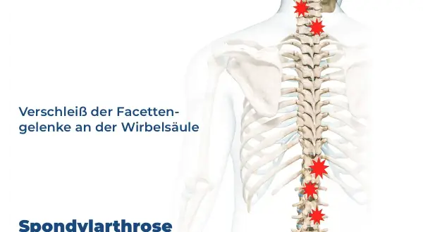 Spondylose mit Radikulopathie: Verschleiß der Facettengelenke an der Wirbelsäule, rot markierte Schmerzpunkte.