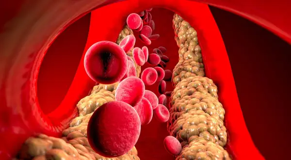 Czerwone krwinki przepływają przez zatłuszczone naczynie krwionośne, gdzie cholesterol HDL podwyższony tworzy złogi.