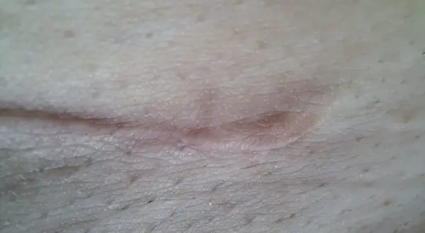 Widoczna blizna po operacji, która zaczyna się goić. Czas rekonwalescencji, czyli jak długo goi się rana po operacji, zależy od wielu czynników.