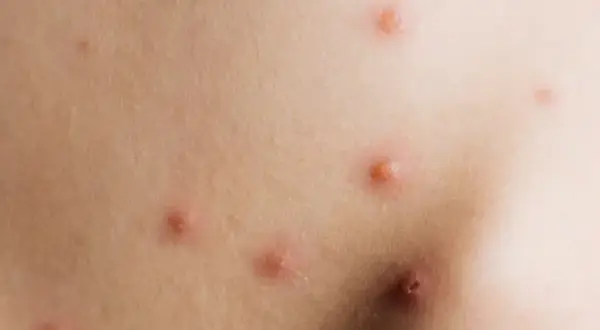Piel con varias picaduras rojas e inflamadas, algunas con un punto central.