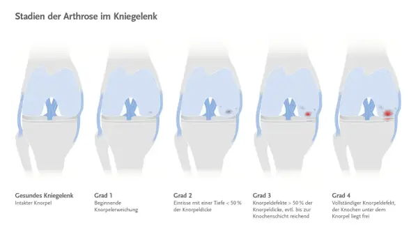 Illustrationen zeigen die Stadien der Arthrose im Kniegelenk, von gesundem Knorpel bis zum vollständigen Knorpeldefekt.