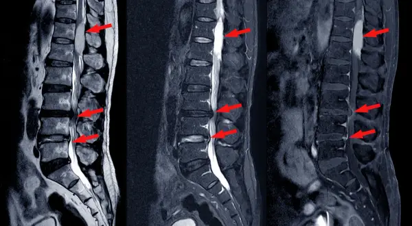 MRI kręgosłupa lędźwiowego pokazuje przepuklinę dysku, która może powodować silny ból. Czerwone strzałki wskazują na ucisk na rdzeń kręgowy.