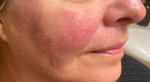 Närbild på en kvinnas kind med synliga blodkärl och rodnad. Finnar på kinderna kan vara ett tecken på rosacea.