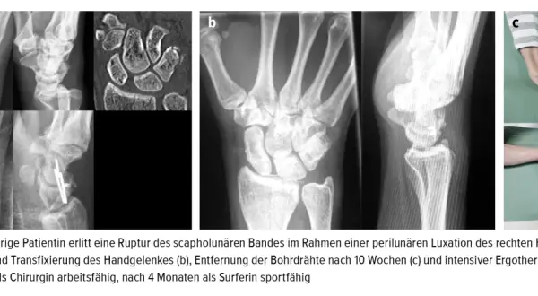 Röntgenbilder zeigen das distale Handgelenk vor und nach einer Operation.
Die Patientin ist nach 3 Monaten wieder arbeitsfähig.