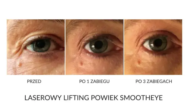 Przed i po zabiegach laserowego liftingu powiek. Efekty widoczne po 1 i 3 zabiegach. Laserowy lifting powiek ile się utrzymuje? Sprawdź efekty!