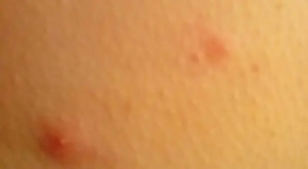 Widoczne czerwone krosty na pośladkach, niektóre z białymi czubkami, świadczą o podrażnieniu skóry.