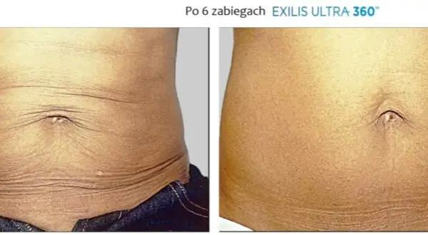 Jak pozbyć się brzucha po porodzie: 8 skutecznych metod