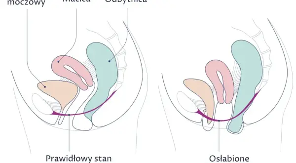 Porównanie prawidłowego i osłabionego dna miednicy. Na drugim obrazku widać obniżenie narządów, co może prowadzić do wypadania pochwy.