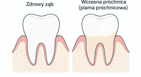 Zdrowy ząb obok zęba z wczesną próchnicą, która zaczyna tworzyć małą dziurę.