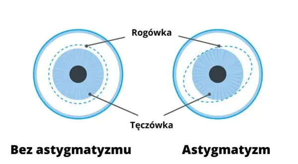 Astygmatyzm: Czy okulary są konieczne? Sprawdź, od czego zależy