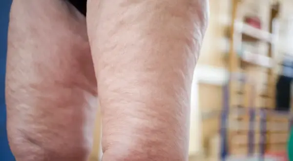 Piernas con celulitis, un primer plano que muestra la textura de la piel y la preocupación por como adelgazar piernas.