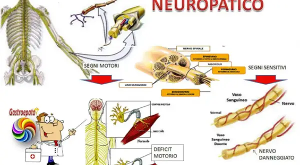 Il dolore neuropatico è illustrato con schemi di nervi, vasi sanguigni e muscoli, mostrando i danni da neuropatia diabetica.