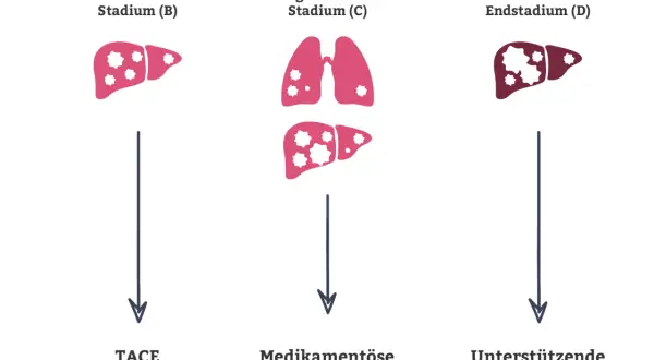 Illustration zeigt Leberstadien mit zunehmenden Metastasen. Stadium B: Leber mit wenigen Metastasen, Therapie TACE/SIRT. Stadium C: Lunge und Leber mit Metastasen, medikamentöse Therapie. Stadium D: Leber mit vielen Metastasen, unterstützende Therapie.