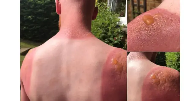 Schwerer Sonnenbrand mit Blasenbildung an Schultern und Nacken. Die Frage "wie lange dauert ein sonnenbrand" wird hier schmerzhaft beantwortet.